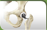 Anterior approach Total Hip Replacement