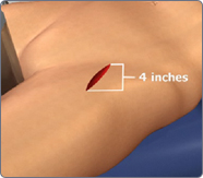 Minimally Invasive Revision THR-Anterior Approach