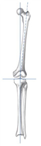 Zimmer® Patient Specific Instruments