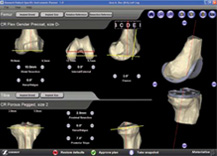 Zimmer® Patient Specific Instruments